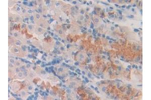 Detection of Slit1 in Human Stomach cancer Tissue using Polyclonal Antibody to Slit Homolog 1 (Slit1)