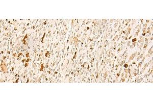 Immunohistochemistry of paraffin-embedded Human gastric cancer tissue using TBPL1 Polyclonal Antibody at dilution of 1:50(x200) (TBPL1 anticorps)