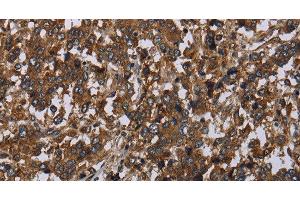 Immunohistochemistry of paraffin-embedded Human liver cancer tissue using HOMER2 Polyclonal Antibody at dilution 1:40 (HOMER2 anticorps)