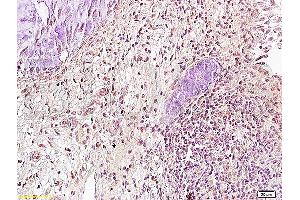 Formalin-fixed and paraffin embedded: human cervical carcinoma labeled with Anti-Runx3 Polyclonal Antibody (ABIN739370), Unconjugated at 1:300, followed by conjugation to the secondary antibody and DAB staining (RUNX3 anticorps)