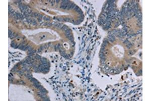 The image on the left is immunohistochemistry of paraffin-embedded Human colon cancer tissue using ABIN7191408(MARVELD1 Antibody) at dilution 1/40, on the right is treated with synthetic peptide. (MARVELD1 anticorps)