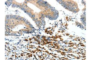 The image on the left is immunohistochemistry of paraffin-embedded Human colon cancer tissue using (PTEN Antibody) at dilution 1/20, on the right is treated with synthetic peptide. (PTEN anticorps)