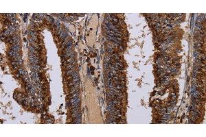 Immunohistochemistry of paraffin-embedded Human colon cancer tissue using PPP1R1B Polyclonal Antibody at dilution 1:50 (DARPP32 anticorps)