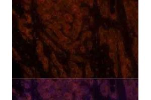 Immunofluorescence analysis of Human liver cancer using CXCL12 Polyclonal Antibody at dilution of 1:100.