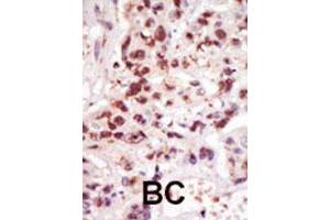 Formalin-fixed and paraffin-embedded human cancer tissue reacted with MAP3K8 polyclonal antibody  , which was peroxidase-conjugated to the secondary antibody, followed by DAB staining.