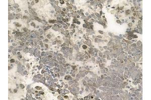 ABIN6257687 and ABIN6274287 at 1/100 staining human melanoma by IHC-P. (CEBPG anticorps  (Internal Region))