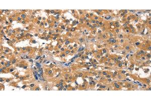 Immunohistochemistry of paraffin-embedded Human thyroid cancer using EIF4G1 Polyclonal Antibody at dilution of 1:30