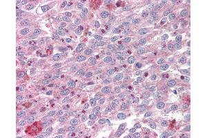 Anti-KLF4 antibody IHC of human melanoma.