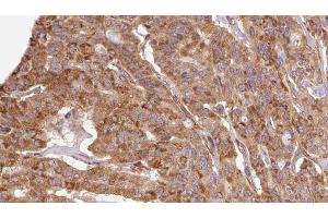 ABIN6267109 at 1/100 staining Human thyroid cancer tissue by IHC-P. (DAB1 anticorps  (pTyr220))
