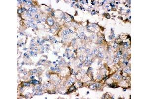 IHC-P: GFRA1 antibody testing of human lung cancer tissue (GFRA1 anticorps  (AA 25-227))