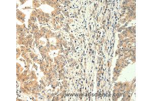 Immunohistochemistry of Human gastric cancer using TRPM5 Polyclonal Antibody at dilution of 1:60 (TRPM5 anticorps)
