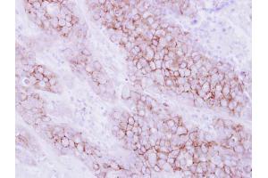 IHC-P Image Immunohistochemical analysis of paraffin-embedded human breast cancer, using KIR2DL4, antibody at 1:250 dilution. (KIR2DL4/CD158d anticorps  (Center))