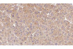 ABIN6277669 at 1/100 staining Human Melanoma tissue by IHC-P.