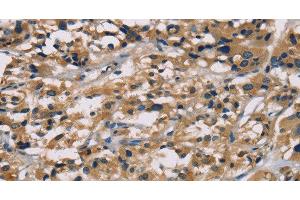 Immunohistochemistry of paraffin-embedded Human thyroid cancer tissue using hCG Polyclonal Antibody at dilution 1:65 (hCG anticorps)