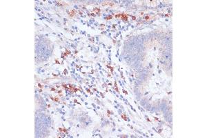 Immunohistochemistry of paraffin-embedded human colon carcinoma using VASP antibody (ABIN6134453, ABIN6150064, ABIN6150065 and ABIN6218508) at dilution of 1:100 (40x lens).