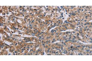 Immunohistochemistry of paraffin-embedded Human prostate cancer using PLXND1 Polyclonal Antibody at dilution of 1:40 (PLXND1 anticorps)