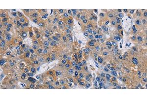 Immunohistochemistry of paraffin-embedded Human liver cancer using GPM6A Polyclonal Antibody at dilution of 1:40 (GPM6A anticorps)