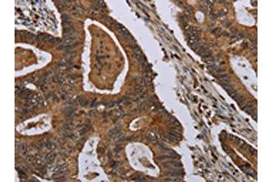 The image on the left is immunohistochemistry of paraffin-embedded Human colon cancer tissue using ABIN7191460(MIG7 Antibody) at dilution 1/35, on the right is treated with synthetic peptide.