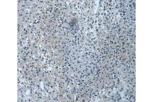 IHC-P analysis of Human Glioma Tissue, with DAB staining. (DVL1 anticorps  (AA 150-285))