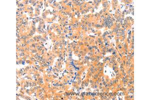 Immunohistochemistry of Human cervical cancer using THBS1 Polyclonal Antibody at dilution of 1:60 (Thrombospondin 1 anticorps)
