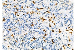 ABIN6258709 and ABIN6275128 at 1/100 staining Human pancreatic cancer and adjacent non-tumor tissue by IHC-P. (FOXD4 anticorps  (Internal Region))