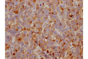 IHC image of ABIN7127430 diluted at 1:100 and staining in paraffin-embedded human breast cancer performed on a Leica BondTM system. (Recombinant Clusterin anticorps)