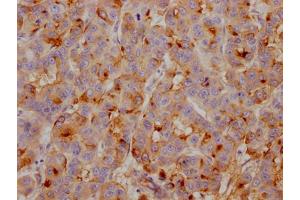 IHC image of ABIN7127430 diluted at 1:100 and staining in paraffin-embedded human breast cancer performed on a Leica BondTM system.