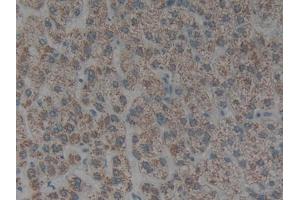 Detection of CK1 in Human Liver cancer Tissue using Polyclonal Antibody to Cytokeratin 1 (CK1)