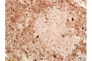 Formalin-fixed and paraffin embedded human melanoma labeled with Anti-CITED1/ABCC1 Polyclonal Antibody, Unconjugated (ABIN682543) at 1:200, followed by conjugation to the secondary antibody and DAB staining