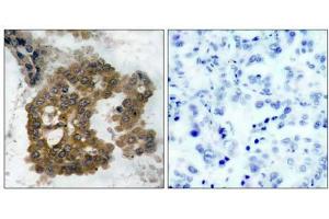 Immunohistochemical analysis of paraffin-embedded human lung carcinoma tissue using Akt2 (phospho- Ser474) antibody (E011124). (AKT2 anticorps  (pSer474))