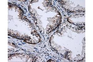 Immunohistochemical staining of paraffin-embedded Adenocarcinoma of breast tissue using anti-PTPRE mouse monoclonal antibody. (PTPRE anticorps)