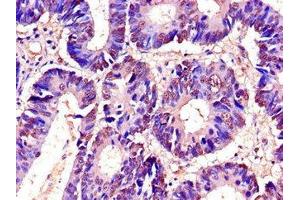 Immunohistochemistry of paraffin-embedded human colon cancer using ABIN7173542 at dilution of 1:100 (C22orf28 anticorps  (AA 52-229))