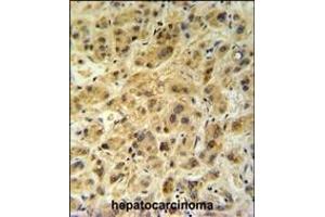 GNS Antibody (Center ) (ABIN390494 and ABIN2840853) IHC analysis in formalin fixed and paraffin embedded human hepatocarcinoma followed by peroxidase conjugation of the secondary antibody and DAB staining. (GNS anticorps  (AA 174-203))