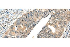 Immunohistochemistry of paraffin-embedded Human colorectal cancer tissue using AIFM2 Polyclonal Antibody at dilution of 1:40(x200) (AIFM2 anticorps)
