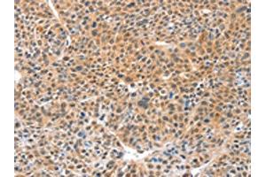 The image on the left is immunohistochemistry of paraffin-embedded Human lung cancer tissue using ABIN7129182(DDX4 Antibody) at dilution 1/20, on the right is treated with fusion protein. (DDX4 anticorps)