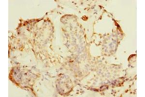 Immunohistochemistry of paraffin-embedded human breast cancer using ABIN7161600 at dilution of 1:100 (NIF3L1 anticorps  (AA 1-377))