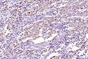 Immunohistochemistry analysis of paraffin-embedded human ovarian cancer using SRFBP1 (ABIN7075579) at dilution of 1: 2000