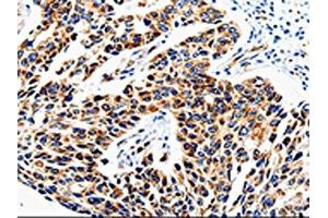 The image is immunohistochemistry of paraffin-embedded Human lung cancer tissue using ABIN7129010(COX16 Antibody) at dilution 1/50. (COX16 anticorps)