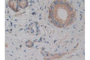 Detection of ACTN4 in Human Bile duct cancer Tissue using Polyclonal Antibody to Actinin Alpha 4 (ACTN4) (alpha Actinin 4 anticorps  (AA 1-269))