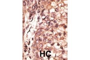 Formalin-fixed and paraffin-embedded human cancer tissue reacted with the primary antibody, which was peroxidase-conjugated to the secondary antibody, followed by DAB staining. (CREB3L1 anticorps  (C-Term))