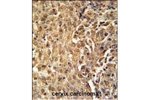 ZC3HAV1 Antibody (C-term) (ABIN651882 and ABIN2840438) immunohistochemistry analysis in formalin fixed and paraffin embedded human cervix carcinoma followed by peroxidase conjugation of the secondary antibody and DAB staining. (ZC3HAV1 anticorps  (C-Term))