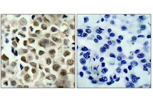 Immunohistochemical analysis of paraffin-embedded human lung carcinoma tissue using HDAC8(Phospho-Ser39) Antibody(left) or the same antibody preincubated with blocking peptide(right). (HDAC8 anticorps  (pSer39))