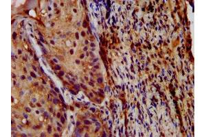 IHC image of ABIN7158410 diluted at 1:200 and staining in paraffin-embedded human lung cancer performed on a Leica BondTM system.