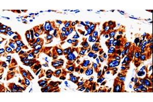 Immunohistochemistry of paraffin-embedded Human lung cancer tissue using UTS2 Polyclonal Antibody at dilution 1:50 (Urotensin 2 anticorps)