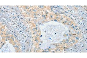Immunohistochemistry of paraffin-embedded Human cervical cancer using CHRNA2 Polyclonal Antibody at dilution of 1:40 (CHRNA2 anticorps)