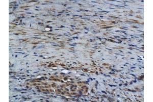 Formalin-fixed and paraffin embedded human colon carcinoma labeled with Rabbit Anti GM-CSF Polyclonal Antibody, Unconjugated  at 1:200 followed by conjugation to the secondary antibody and DAB staining (GM-CSF anticorps  (AA 65-144))