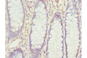 Immunohistochemistry of paraffin-embedded human colon cancer using ABIN7168204 at dilution of 1:100 (RPS6KL1 anticorps  (AA 1-130))