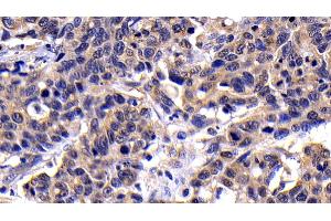 Detection of CASP8 in Human Lymphoma Tissue using Polyclonal Antibody to Caspase 8 (CASP8)