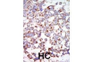 Formalin-fixed and paraffin-embedded human cancer tissue reacted with the primary antibody, which was peroxidase-conjugated to the secondary antibody, followed by AEC staining.