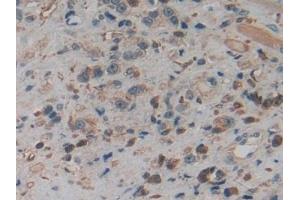 Detection of PKM2 in Human Prostate cancer Tissue using Polyclonal Antibody to Pyruvate kinase isozymes M2 (PKM2)